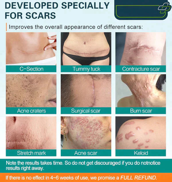 ⚡️LOVILDS™ Advanced Scar Spray For All Types of Scars - For example Acne Scars, Surgical Scars and Stretch Marks