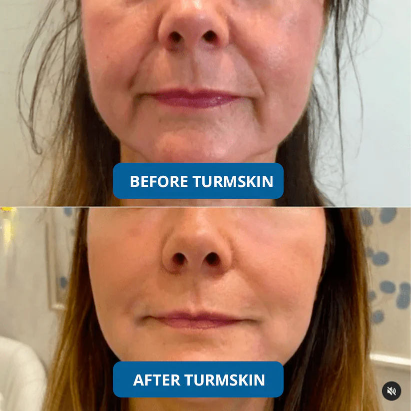 3% Hyaluronic Acid Ultra Hydrating Serum by TurmSkin