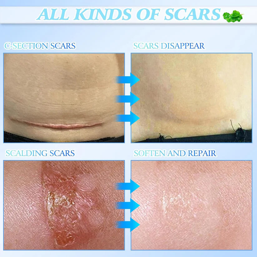 🔥Limited Time Offer🔥Skin Smoothing Scar Cream, Lighten & Repair All Scars