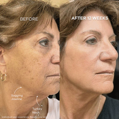 The Micro Infusion System™  Visibly Diminish Wrinkles & Sagging In 12 Weeks