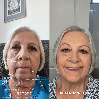 The Micro Infusion System™  Visibly Diminish Wrinkles & Sagging In 12 Weeks