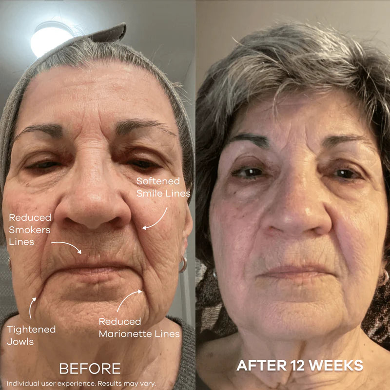 The Micro Infusion System™  Visibly Diminish Wrinkles & Sagging In 12 Weeks