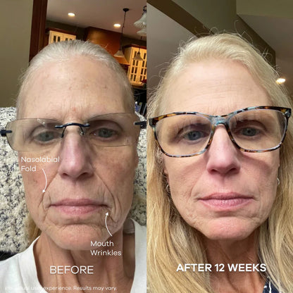 The Micro Infusion System™  Visibly Diminish Wrinkles & Sagging In 12 Weeks